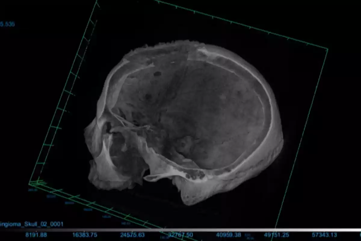 Imagen de una tomografía computarizada en 3D de un cráneo humano mostrando detalles óseos.