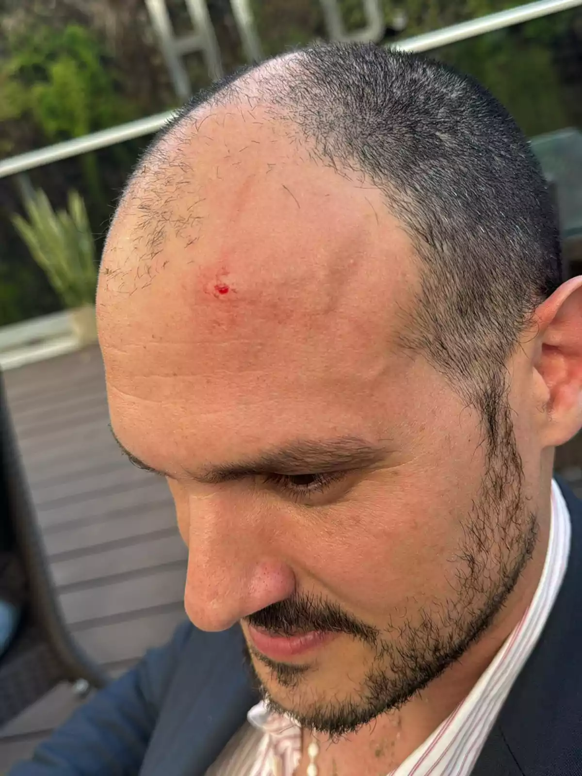 Un hombre con barba y cabello corto tiene una pequeña herida en la frente mientras está al aire libre.