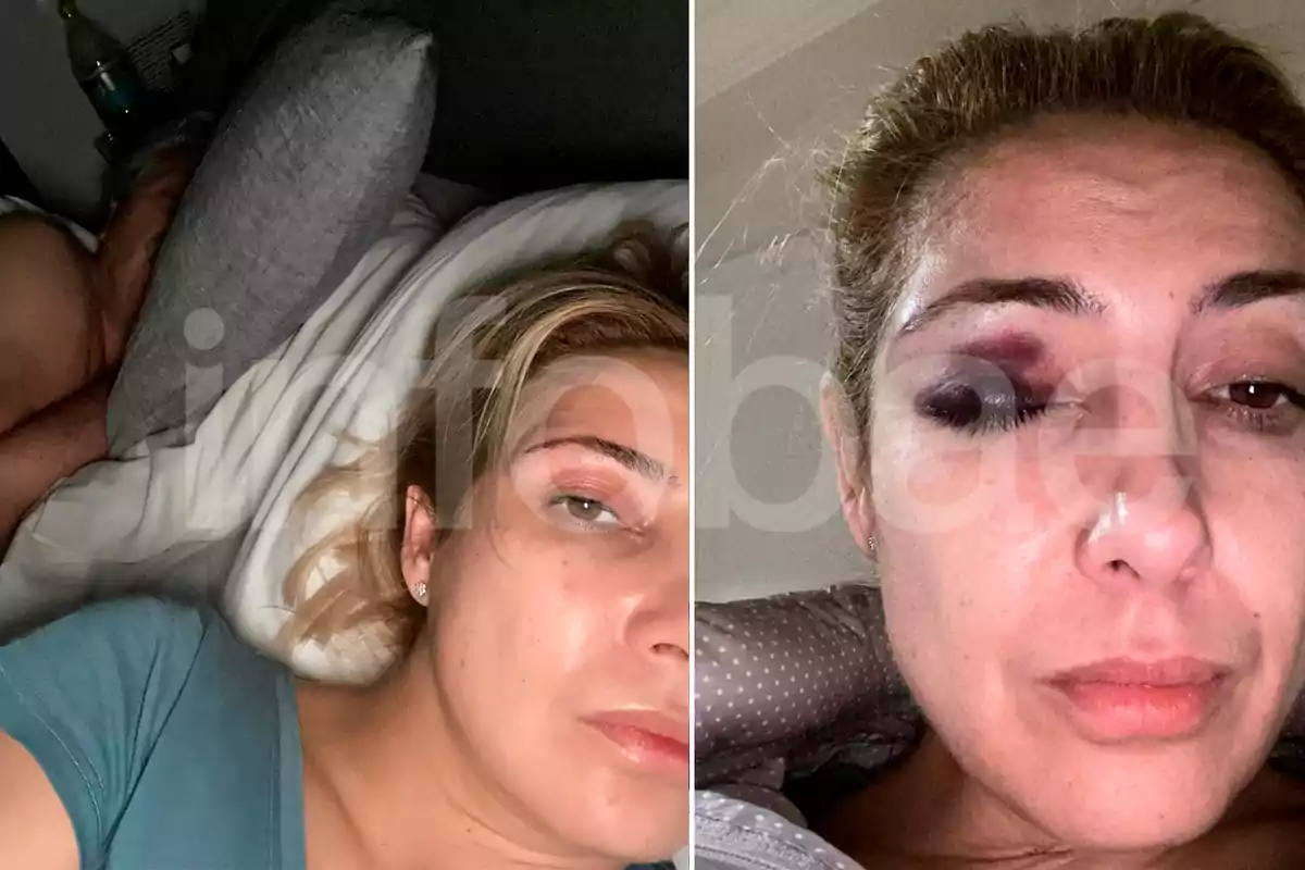 Una mujer con un ojo morado se toma una selfie en la cama, mientras un hombre duerme a su lado.